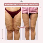 Leggings Bloomi 3D: dì addio al dolore e al gonfiore del lipedema in modo naturale
