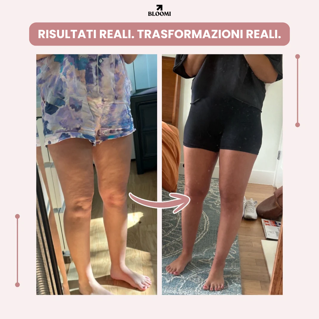 Leggings Bloomi 3D: dì addio al dolore e al gonfiore del lipedema in modo naturale